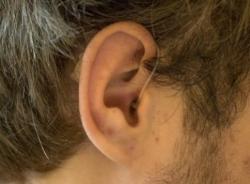 Открытое слухопротезирование слуховыми аппаратами серии Life