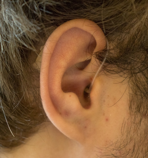 Слухопротезирование слуховыми аппаратами